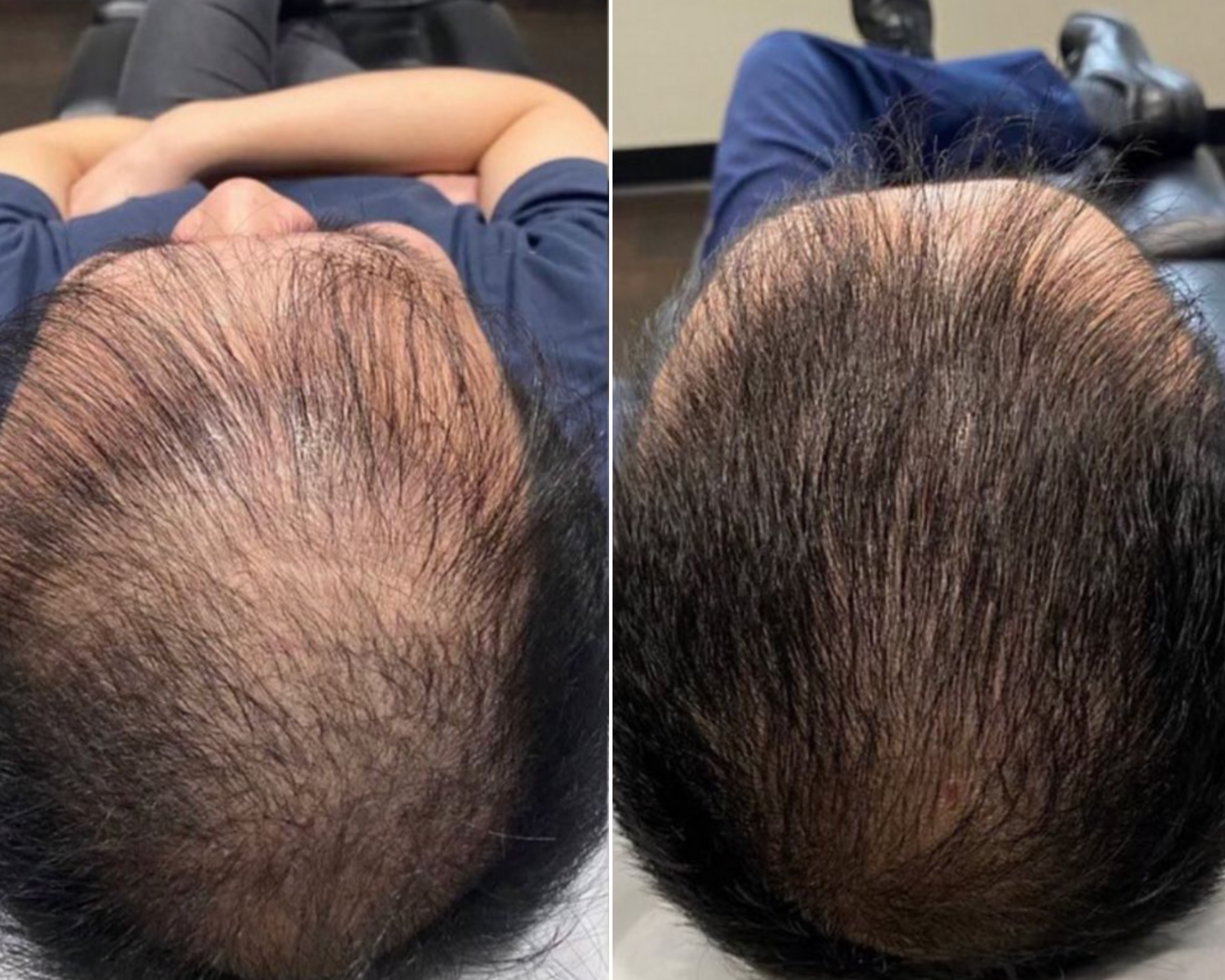 PRP Hair Treatment | PRP for Hair Loss | Platelet Rich Plasma Hair Treatment | New Hair Clinic PRP Hair Treatment | PRP for Hair Loss | Platelet Rich Plasma Hair Treatment | New Hair Clinic